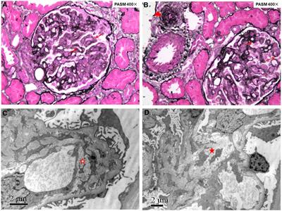 Prominent renal complications associated with MMACHC pathogenic variant c.80A > G in Chinese children with cobalamin C deficiency